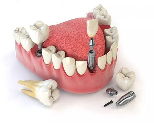 1636360677644612.jpg Teeth implant Titanium parts.jpg
